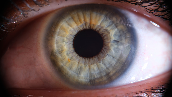 Inflamed reddened eye of girl closeup. Expansion of vessels of eye and tension from computer