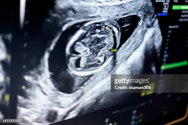 doctor used an ultrasound sonogram  monitor for  the fetus 12 weeks patient pregnant - foetus stockfoto's en -beelden