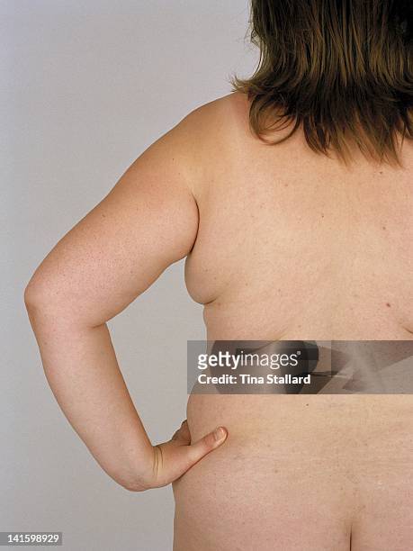An anonymous woman before her weight loss surgery. She weighs nearly 20 stone and is severely obese. She hopes to lose around a third of her weight...