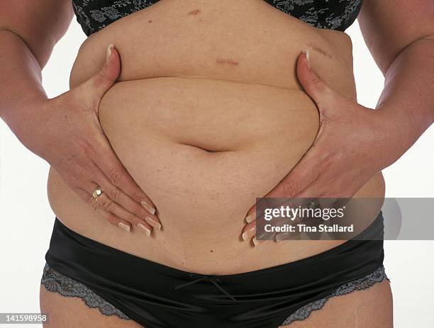 An anonymous woman holds up the rolls of fat on her stomach nearly two years after she had a gastric band fitted to help her lose weight. The scars...