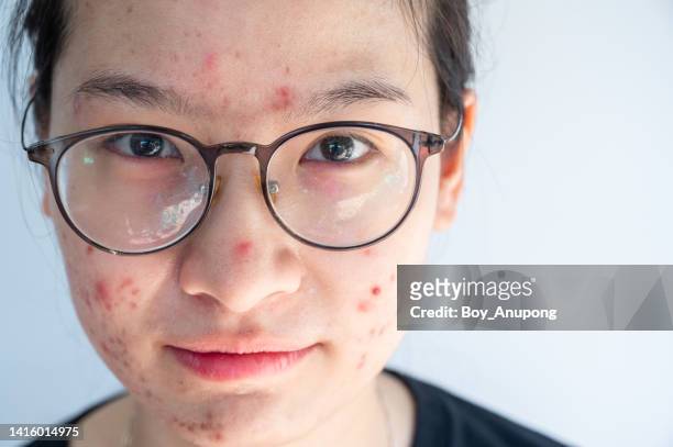 headshot of young asian woman having acne inflammation occur on her face. natural skin of person without make-up. - brille kaputt stock-fotos und bilder