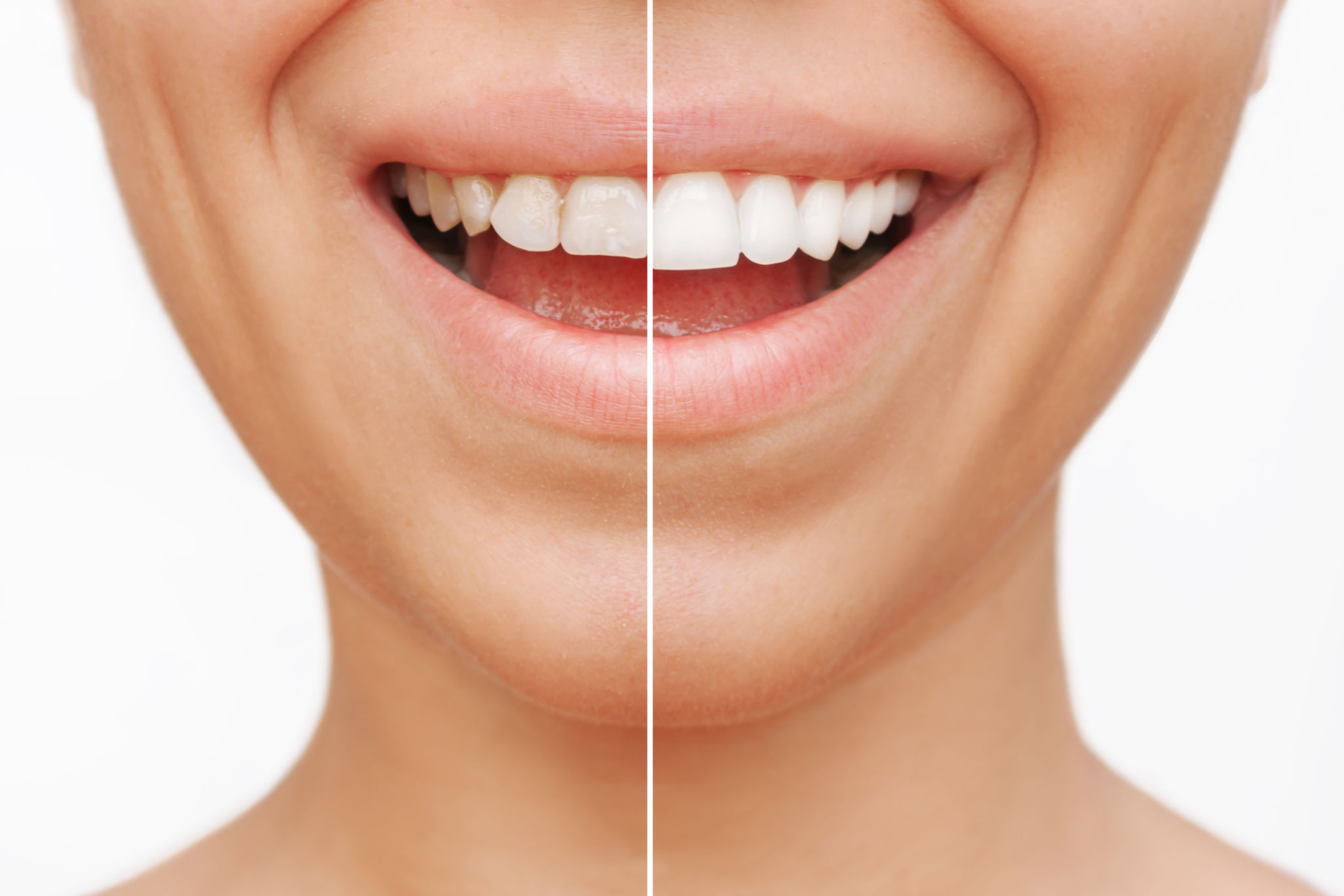 before and after dental