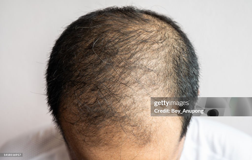 Top view of baldness men's head with thin hair on his top and forehead. Conceptual of hair problem on men's head.