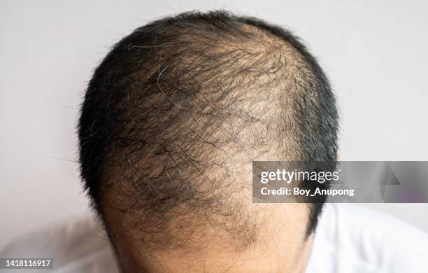 top view of baldness men's head with thin hair on his top and forehead. conceptual of hair problem on men's head. - hair fall stock pictures, royalty-free photos & images