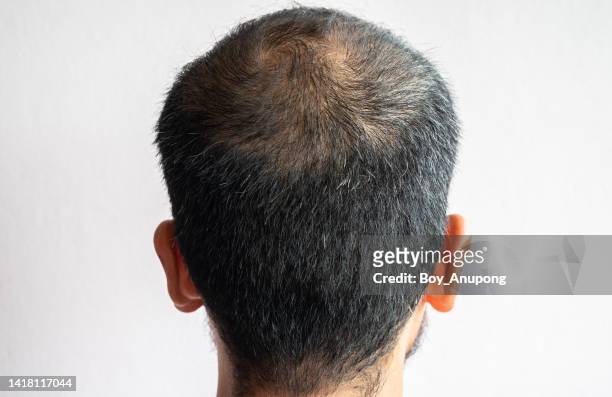 a bald spot on men's head. conceptual of hair problem on men's head. - cheveux court homme photos et images de collection