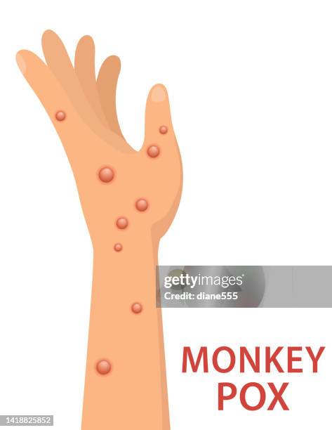 hand with monkey pox poster - mpox stock illustrations