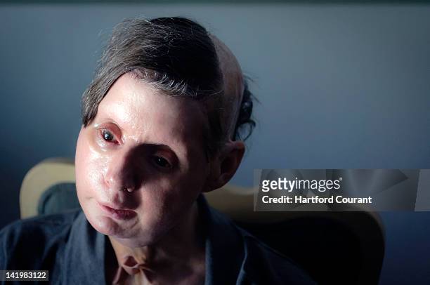Charla Nash, of Stamford, Connecticut, pictured March 21 was so severely mauled by Sandra Herold's 200-pound pet chimpanzee Travis, that she lost her...