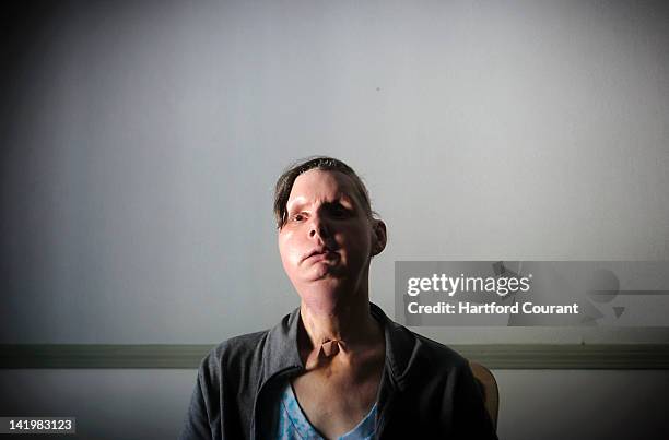 Charla Nash, of Stamford, Connecticut, pictured March 21 was so severely mauled by Sandra Herold's 200-pound pet chimpanzee Travis, that she lost her...