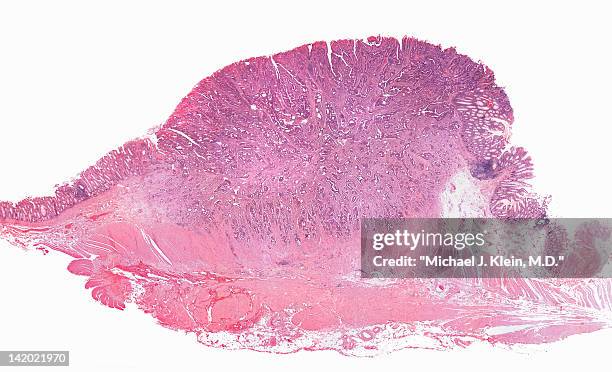 close up of invasive colon cancer cells - colorectal cancer stockfoto's en -beelden