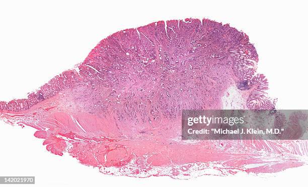 close up of invasive colon cancer cells - colon cancer stock pictures, royalty-free photos & images