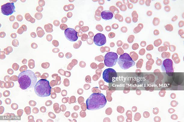 close up of myelogenous leukemia cells - leucemia foto e immagini stock