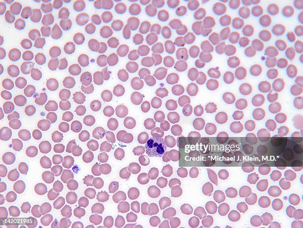malarial blood cells - plasmódio - fotografias e filmes do acervo