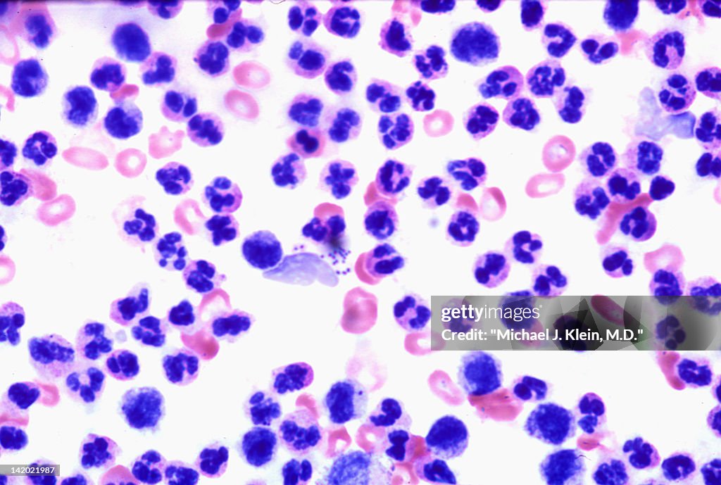 Fluid aspirate from staph infection