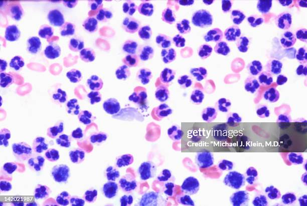 fluid aspirate from staph infection - staphylococcal enterotoxicosis stock pictures, royalty-free photos & images