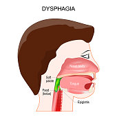 Dysphagia. aspiration food or liquid into the lungs