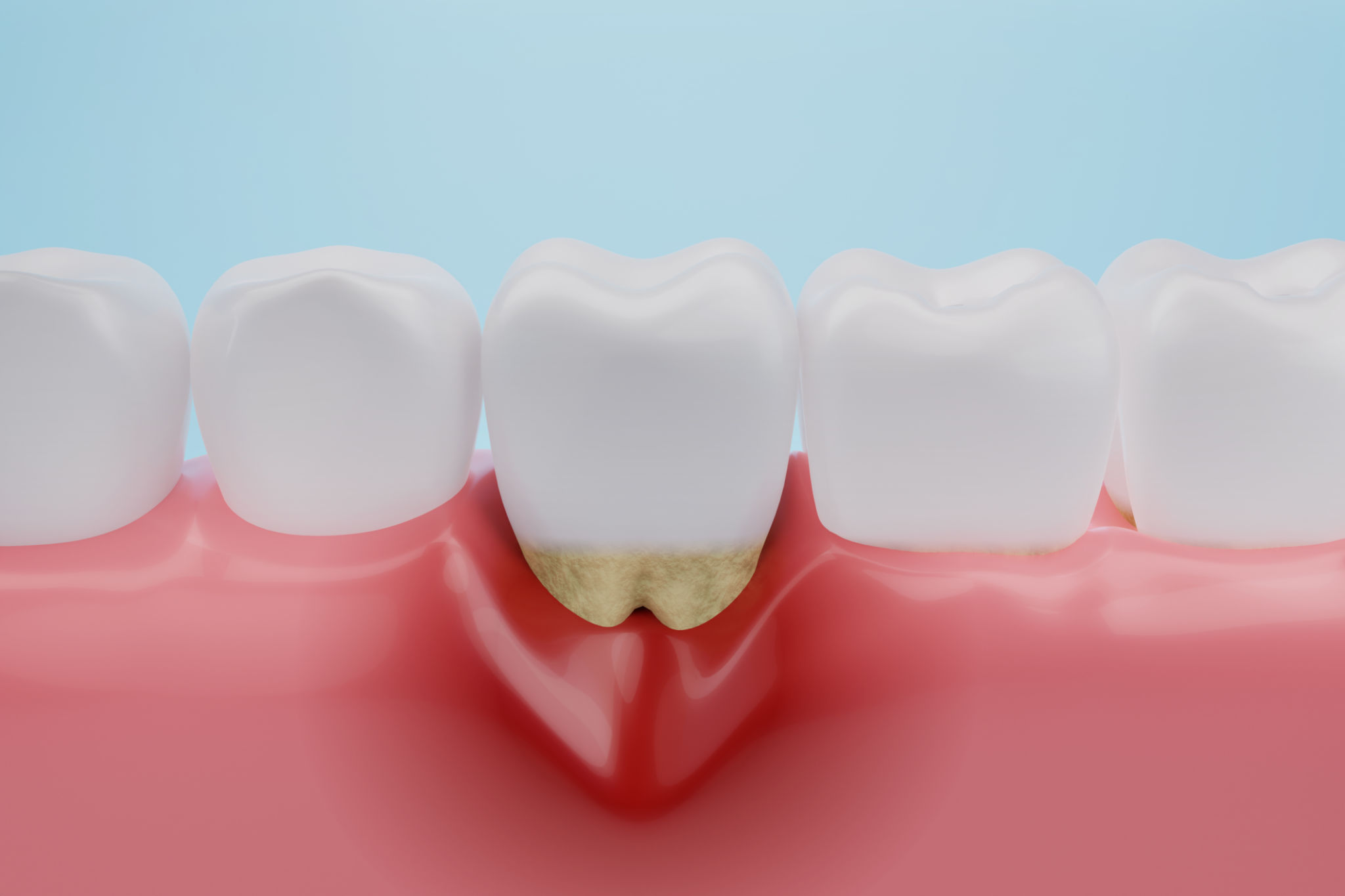 gum disease illustration