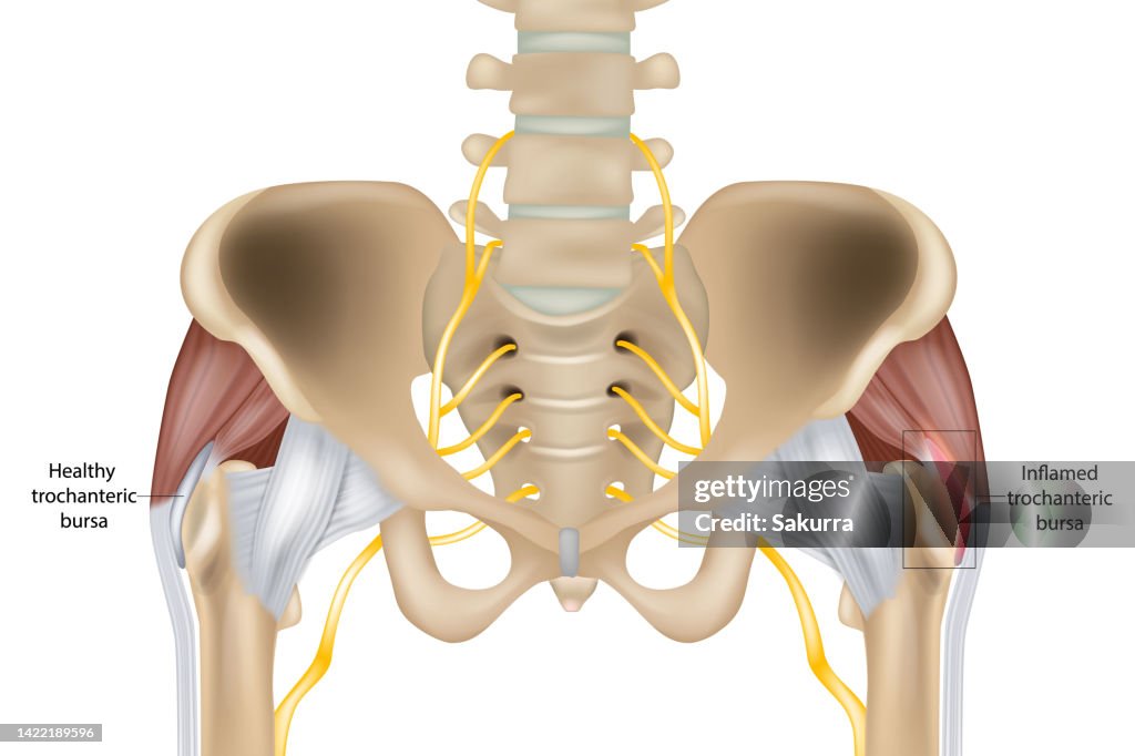 Gtb Injection Hip Trochanteric Bursitis Is Inflammation Of The Bursa Healthy And ...