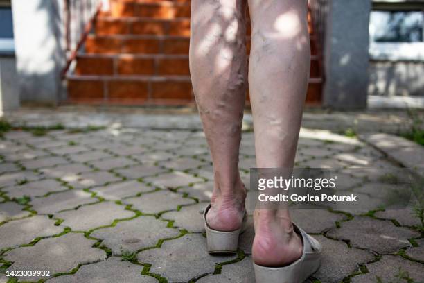 las varices en una mujer de las piernas - coágulo de sangre fotografías e imágenes de stock