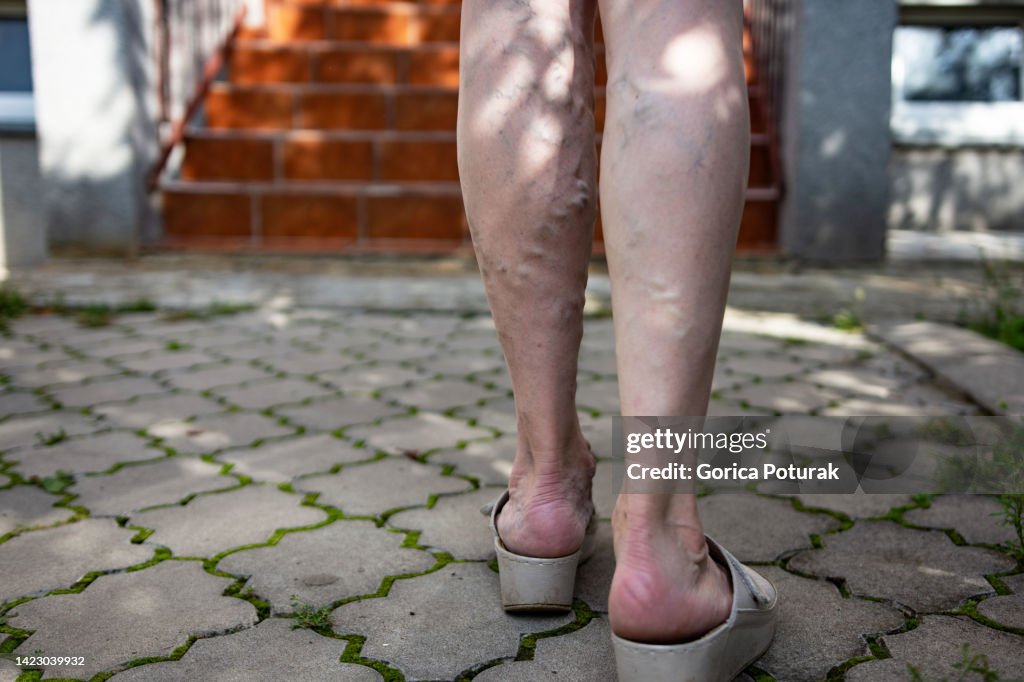 Varicose veins on a female legs