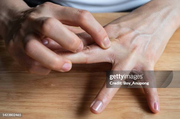 unidentified woman scratching her skin caused of hand eczema problem. - queimadura pele - fotografias e filmes do acervo