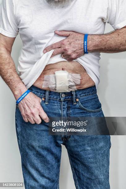 senior man looking down at abdominal cancer surgery bandage - postoperatief stockfoto's en -beelden