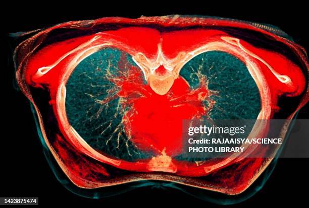 normal lung, ct scan - vía-respiratoria fotografías e imágenes de stock
