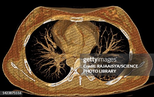 High Resolution Ct Normal Lung Ct Scan High-Res Stock Photo - Getty Images