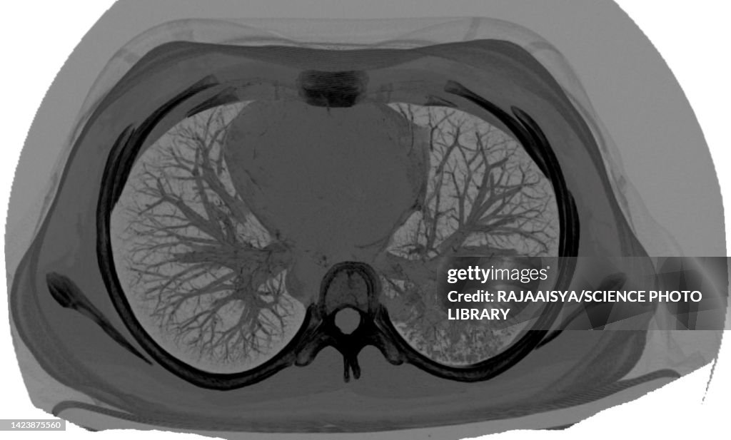 High Resolution Ct Normal Lung Ct Scan High-Res Stock Photo - Getty Images