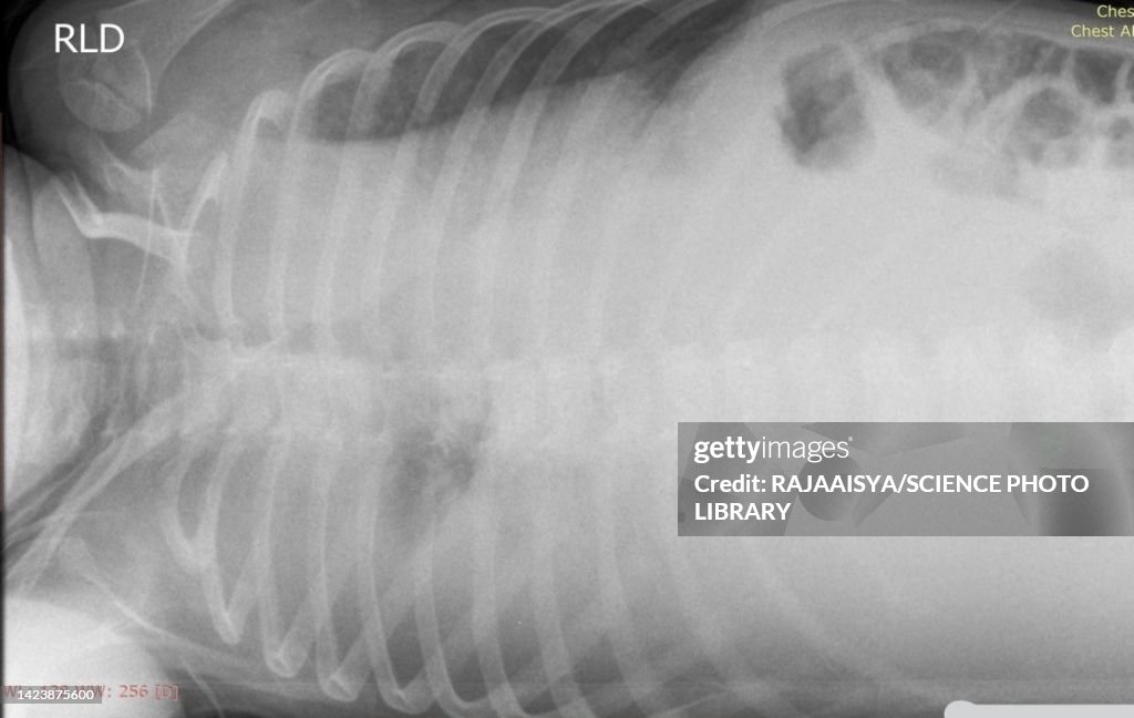 Pleural effusion, X-ray