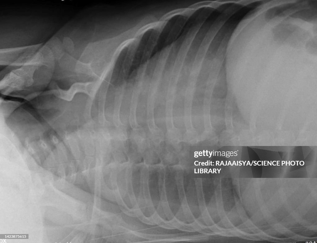Pleural effusion, X-ray