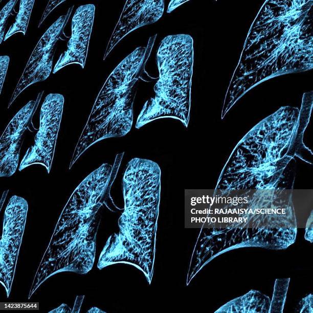 lungs, ct scan - lunga bildbanksfoton och bilder