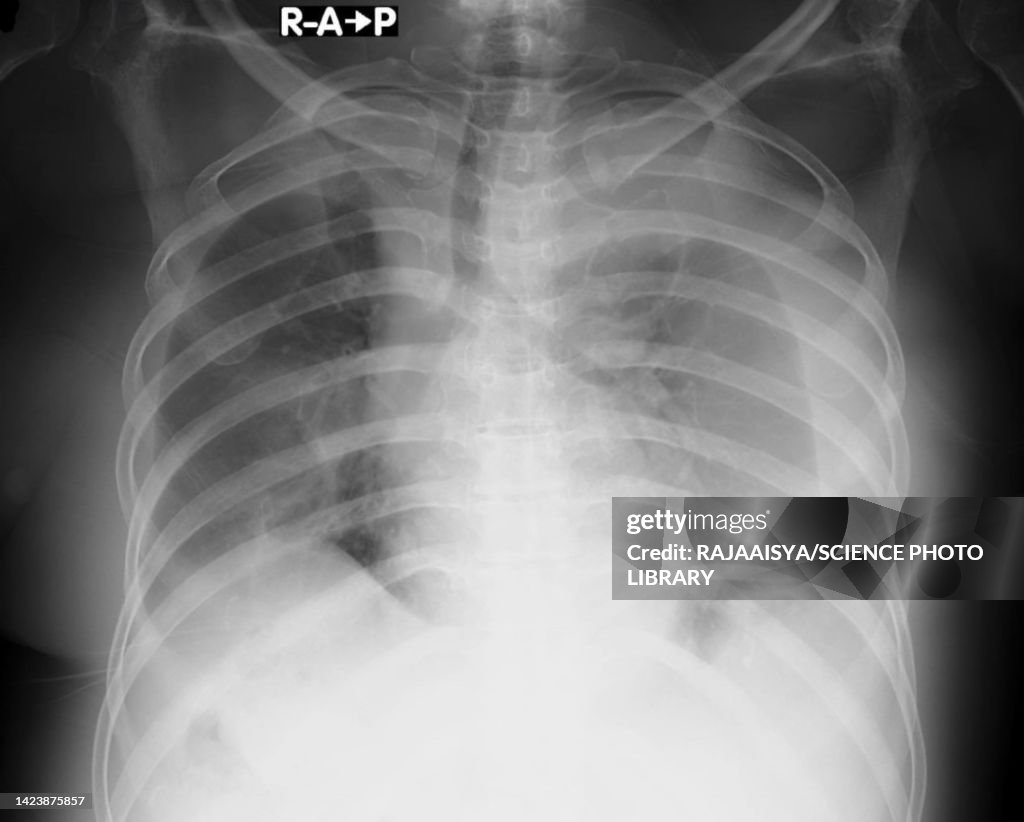 Pleural effusion, X-ray