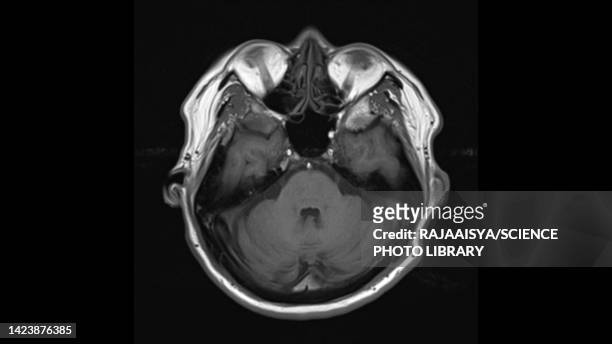 healthy brain, mri scan - brain stem photos et images de collection