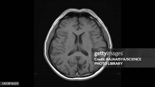 healthy brain, mri scan - zijventrikel stockfoto's en -beelden