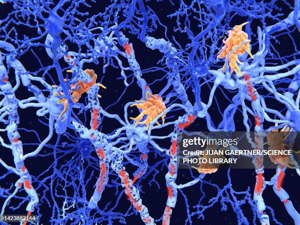 ilustraciones, imágenes clip art, dibujos animados e iconos de stock de nerve damage in multiple sclerosis, illustration - autoimmunity