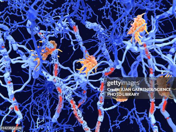 bildbanksillustrationer, clip art samt tecknat material och ikoner med nerve damage in multiple sclerosis, illustration - myelinskida