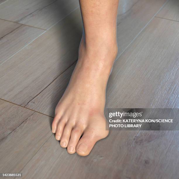 bunion, illustration - malnutrition stock illustrations