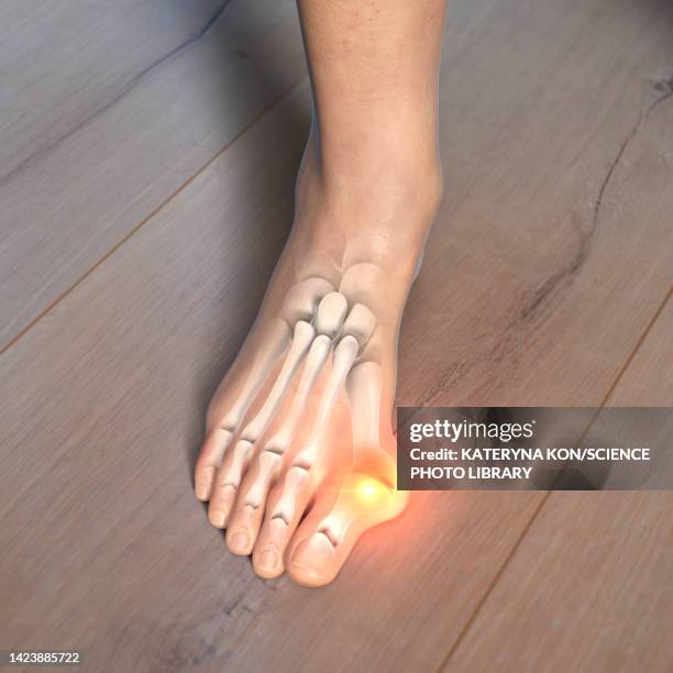 bunion, illustration - hallux valgus stock illustrations