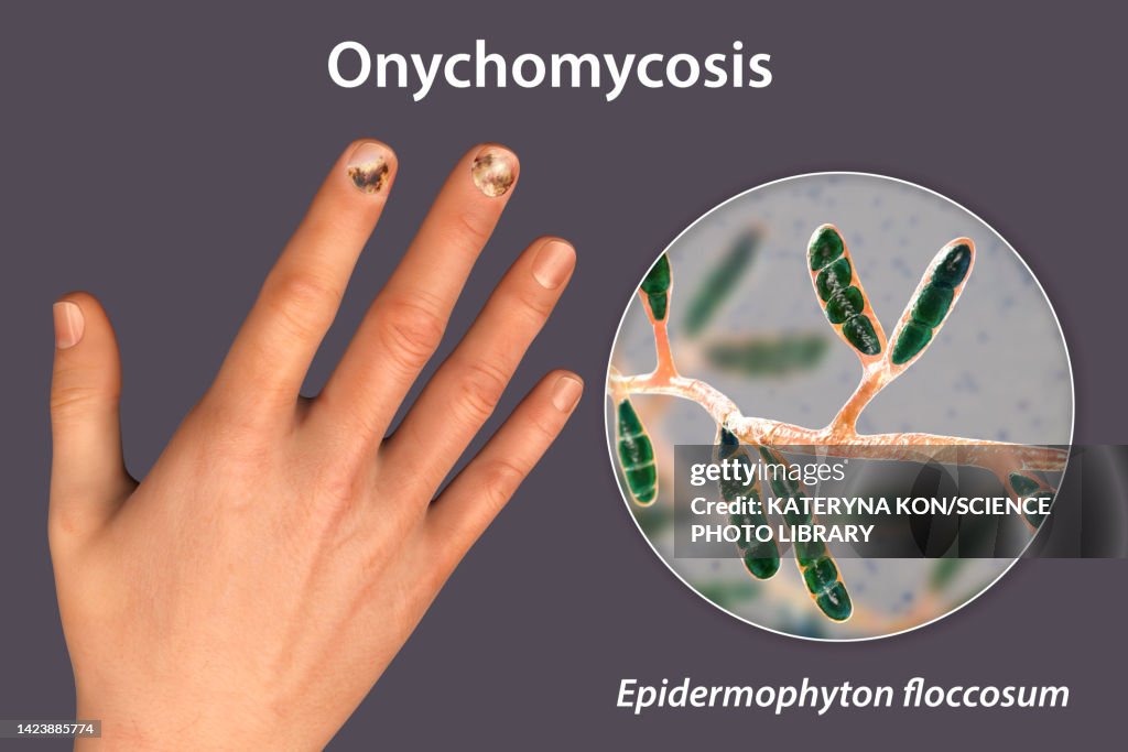 Fungal nail infection, illustration