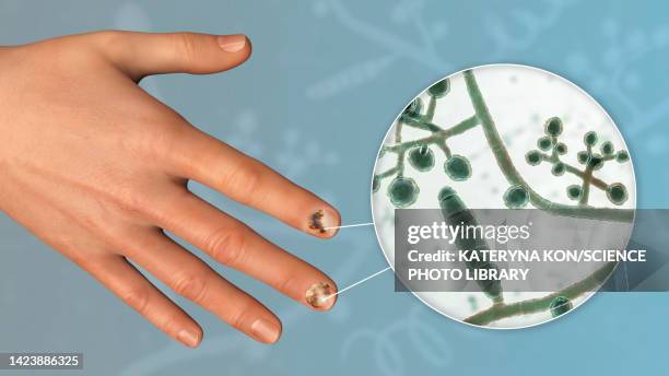 fungal nail infection, illustration - onychomycosis stock illustrations