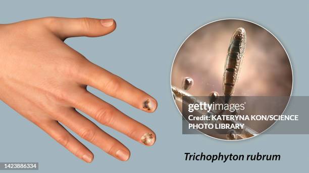 fungal nail infection, illustration - onychomycosis stock illustrations