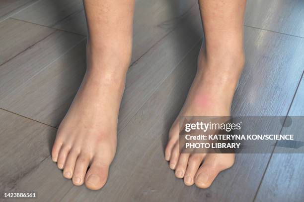 bunion, illustration - hallux valgus stock illustrations