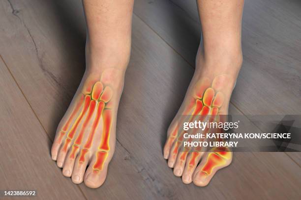 bunion, illustration - human toe stock illustrations