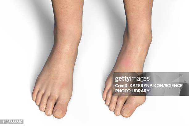 bunion, illustration - hallux valgus 幅插畫檔、美工圖案、卡通及圖標