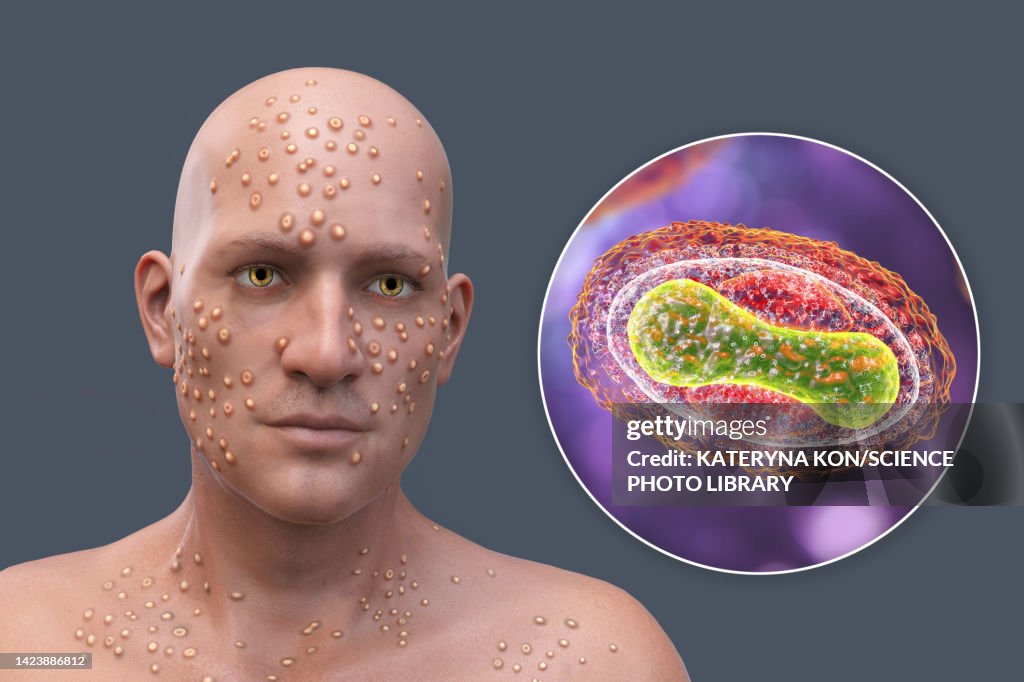 Getting Smallpox Smallpox Virus Infection Illustration High-Res Vector Graphic - Getty ...