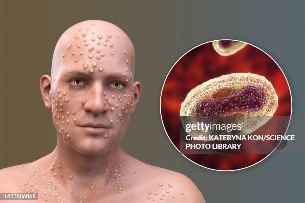 Smallpox Contain Smallpox Molecule Photos and Premium High Res Pictures - Getty Images