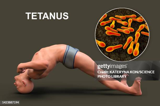 stockillustraties, clipart, cartoons en iconen met opisthotonus in a man with tetanus, illustration - clostridium tetani