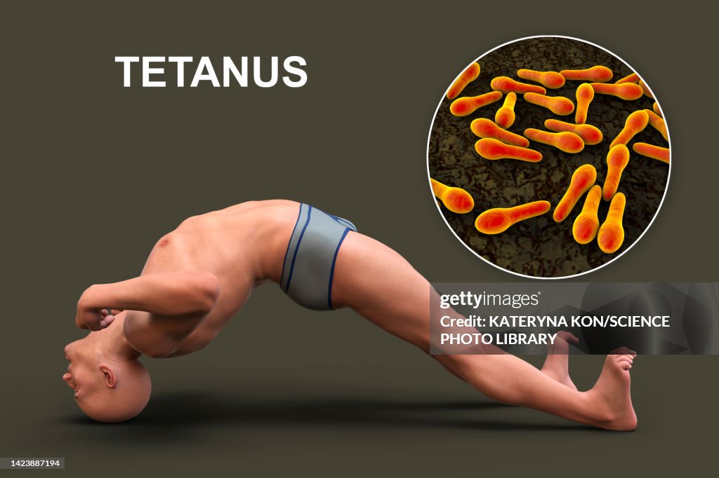 Tetanus Graphics Opisthotonus In A Man With Tetanus Illustration High-Res Vector Graphic ...