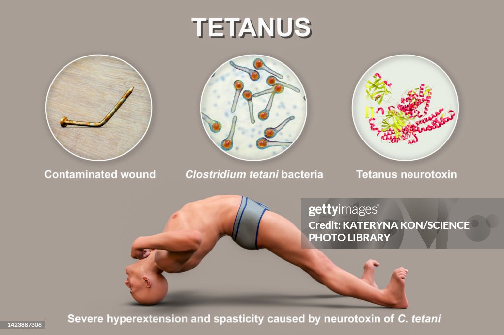 Mechanism Of Tetanus Disease Illustration Illustration Getty Images mechanism-of-tetanus-disease-illustration-illustration-getty-images