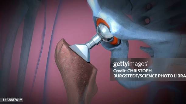 ilustrações, clipart, desenhos animados e ícones de hip replacement, illustration - bacia artificial